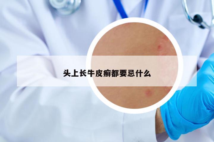 頭上長(zhǎng)牛皮癬都要忌什么