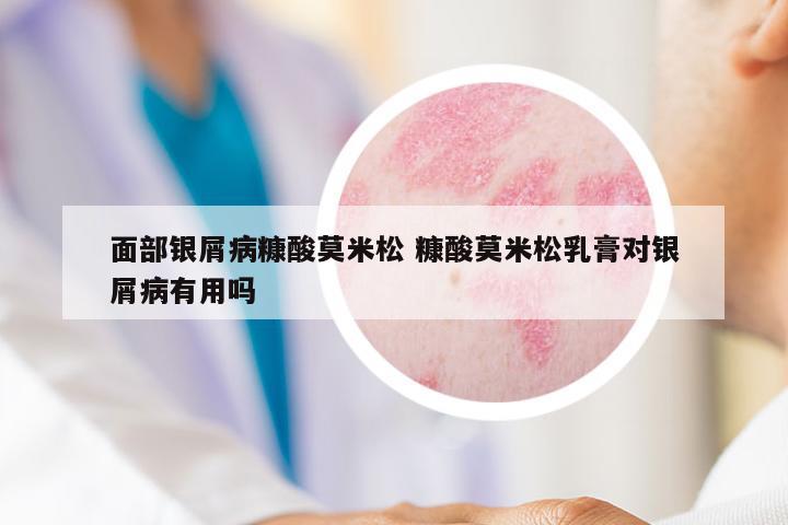 面部銀屑病糠酸莫米松 糠酸莫米松乳膏對銀屑病有用嗎