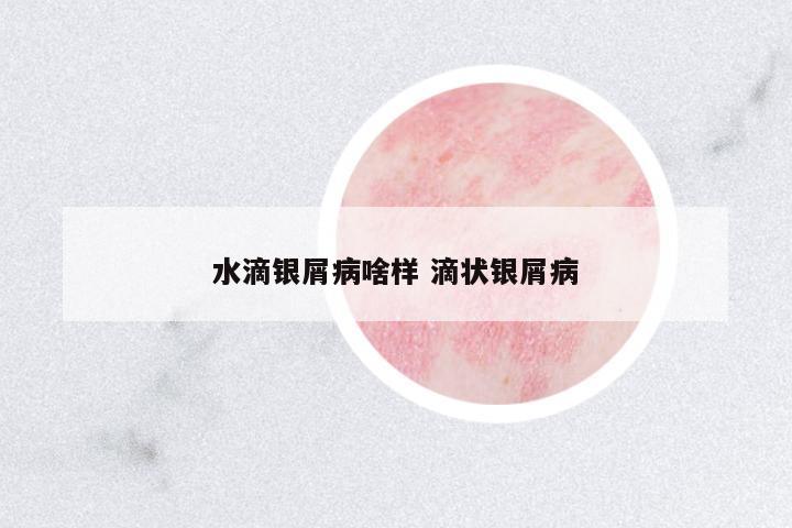 水滴銀屑病啥樣 滴狀銀屑病
