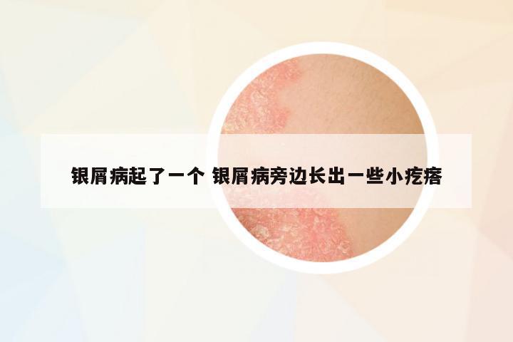 銀屑病起了一個(gè) 銀屑病旁邊長(zhǎng)出一些小疙瘩