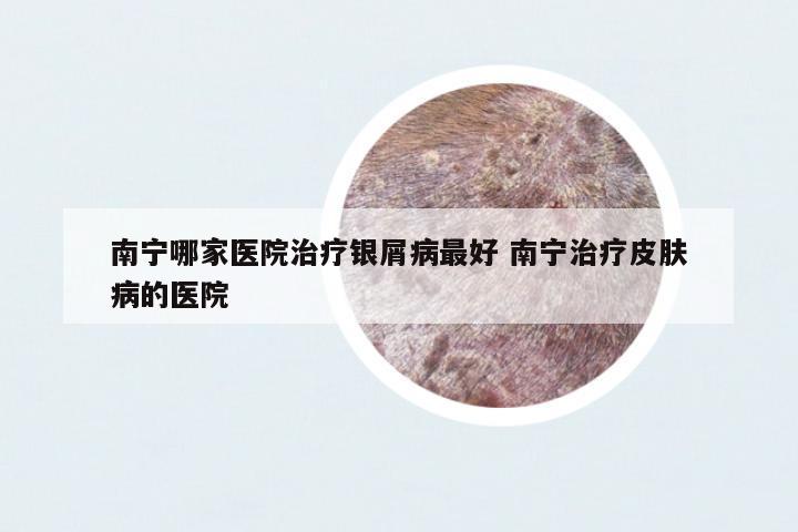 南寧哪家醫(yī)院治療銀屑病最好 南寧治療皮膚病的醫(yī)院