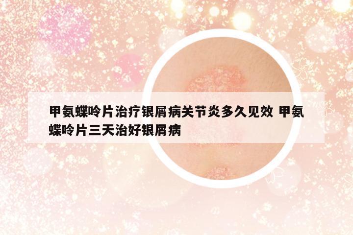甲氨蝶呤片治療銀屑病關(guān)節(jié)炎多久見效 甲氨蝶呤片三天治好銀屑病