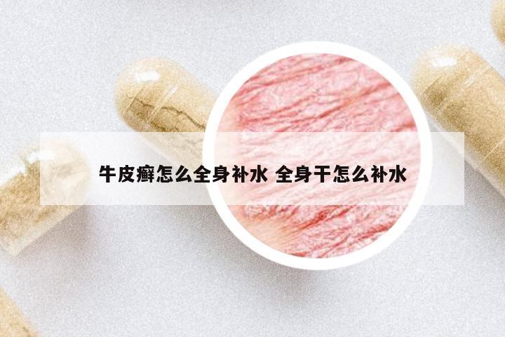 牛皮癬怎么全身補(bǔ)水 全身干怎么補(bǔ)水
