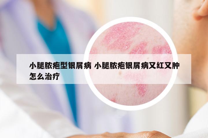 小腿膿皰型銀屑病 小腿膿皰銀屑病又紅又腫怎么治療