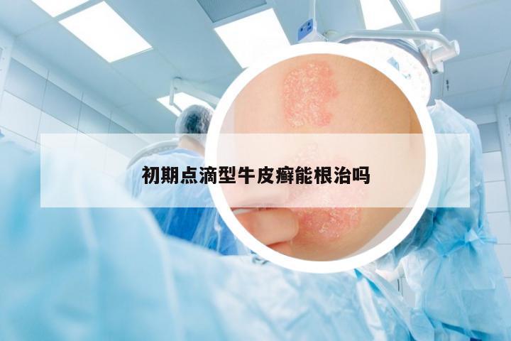 初期點(diǎn)滴型牛皮癬能根治嗎
