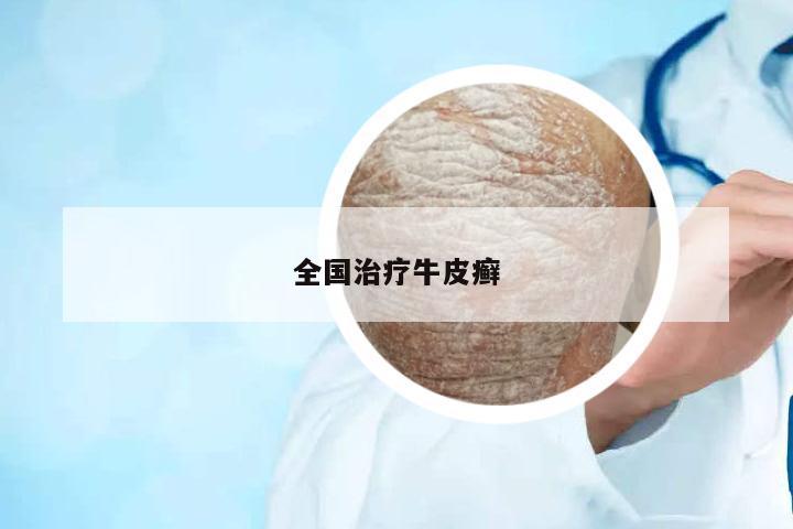 全國治療牛皮癬