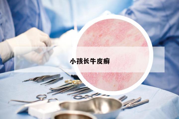 小孩長(zhǎng)牛皮癬