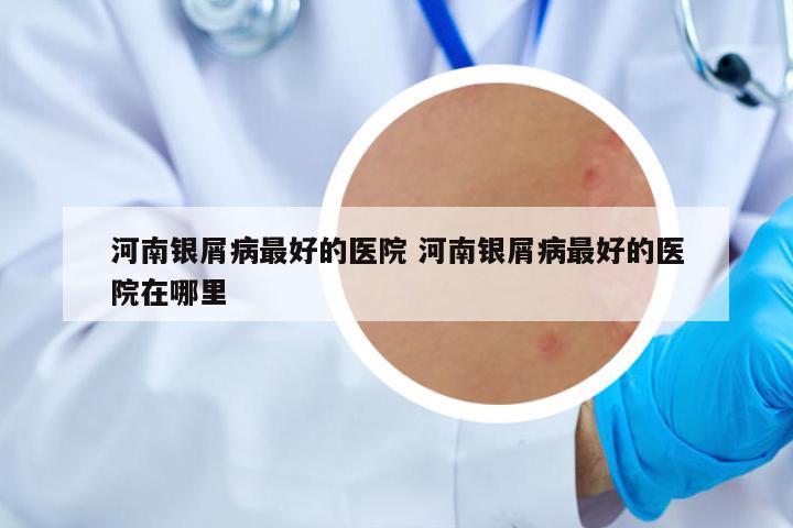 河南銀屑病最好的醫(yī)院 河南銀屑病最好的醫(yī)院在哪里