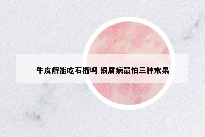 牛皮癬能吃石榴嗎 銀屑病最怕三種水果