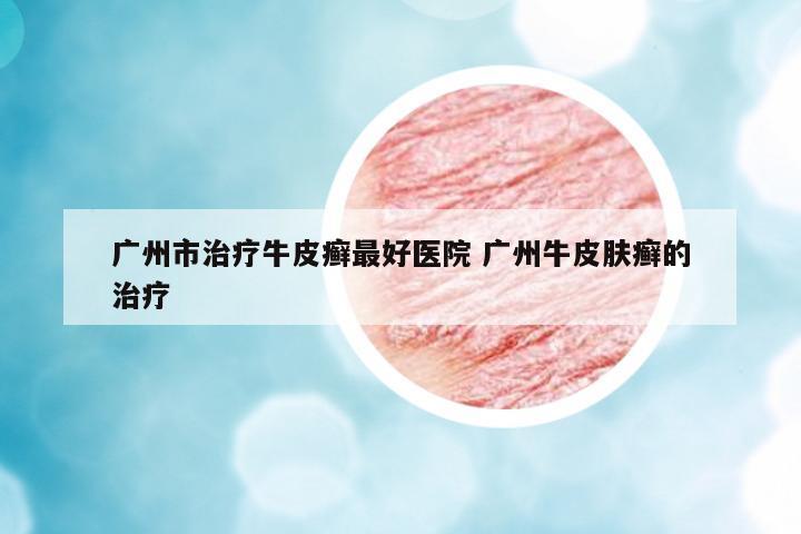 廣州市治療牛皮癬最好醫(yī)院 廣州牛皮膚癬的治療