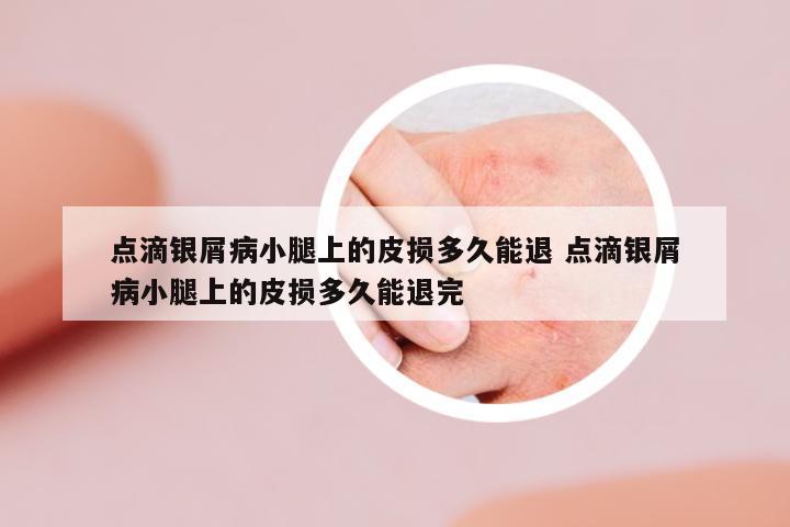 點(diǎn)滴銀屑病小腿上的皮損多久能退 點(diǎn)滴銀屑病小腿上的皮損多久能退完
