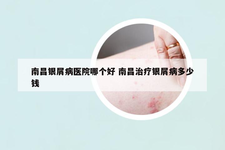 南昌銀屑病醫(yī)院哪個(gè)好 南昌治療銀屑病多少錢(qián)
