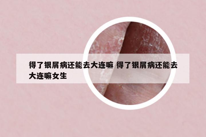 得了銀屑病還能去大連嘛 得了銀屑病還能去大連嘛女生