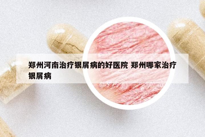 鄭州河南治療銀屑病的好醫(yī)院 鄭州哪家治療銀屑病