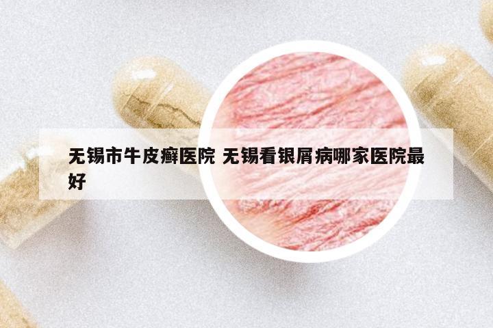 無錫市牛皮癬醫(yī)院 無錫看銀屑病哪家醫(yī)院最好