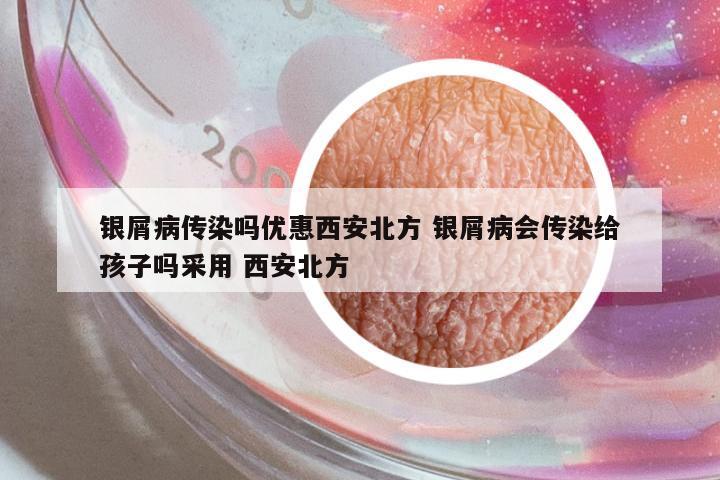 銀屑病傳染嗎優(yōu)惠西安北方 銀屑病會傳染給孩子嗎采用 西安北方