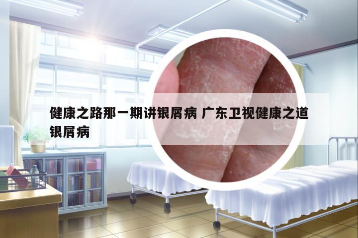 健康之路那一期講銀屑病 廣東衛(wèi)視健康之道銀屑病