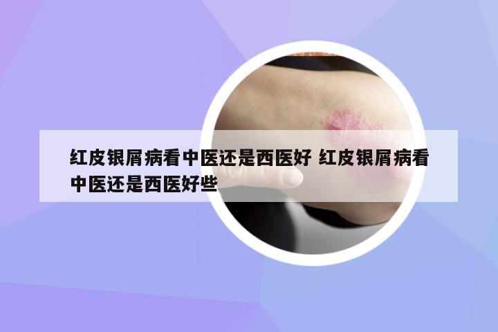 紅皮銀屑病看中醫(yī)還是西醫(yī)好 紅皮銀屑病看中醫(yī)還是西醫(yī)好些