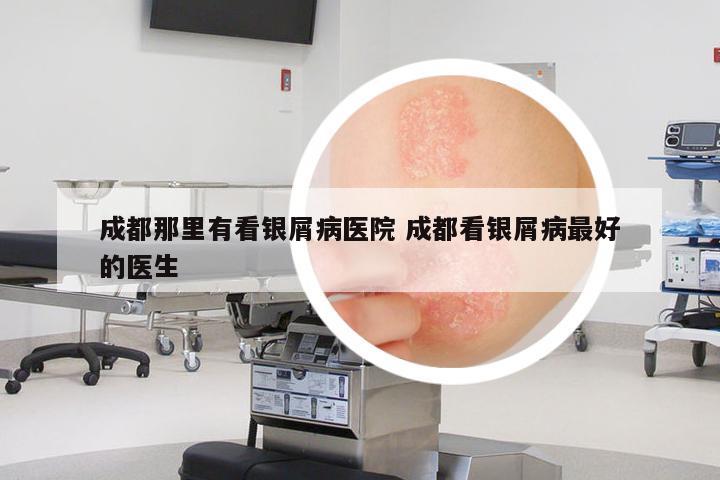 成都那里有看銀屑病醫(yī)院 成都看銀屑病最好的醫(yī)生