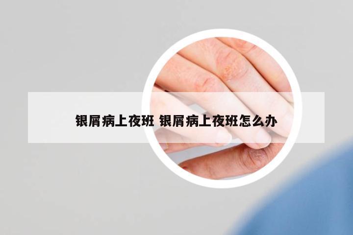 銀屑病上夜班 銀屑病上夜班怎么辦