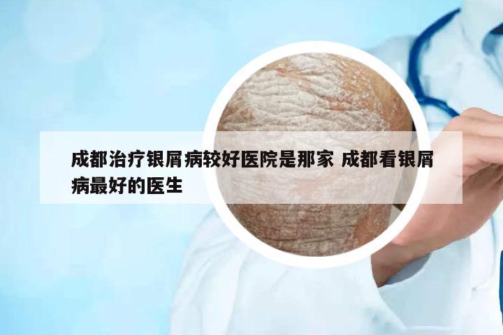 成都治療銀屑病較好醫(yī)院是那家 成都看銀屑病最好的醫(yī)生