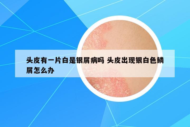 頭皮有一片白是銀屑病嗎 頭皮出現(xiàn)銀白色鱗屑怎么辦