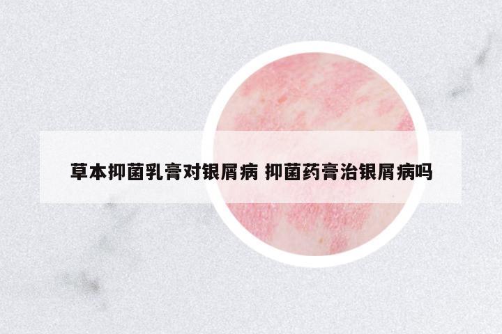 草本抑菌乳膏對(duì)銀屑病 抑菌藥膏治銀屑病嗎