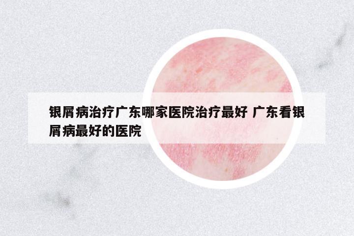 銀屑病治療廣東哪家醫(yī)院治療最好 廣東看銀屑病最好的醫(yī)院