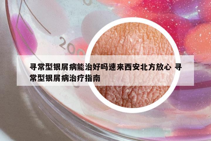 尋常型銀屑病能治好嗎速來西安北方放心 尋常型銀屑病治療指南
