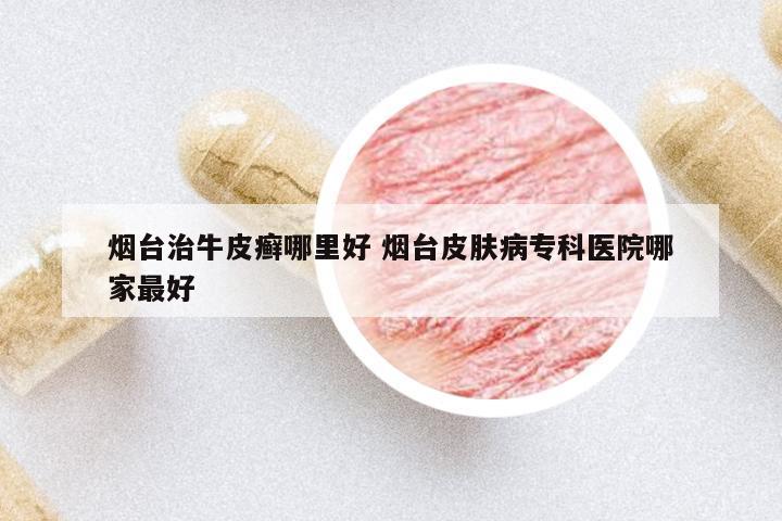 煙臺治牛皮癬哪里好 煙臺皮膚病專科醫(yī)院哪家最好