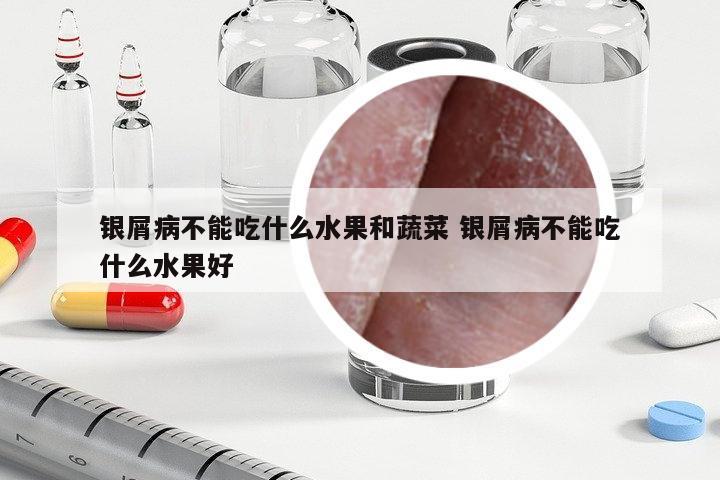 銀屑病不能吃什么水果和蔬菜 銀屑病不能吃什么水果好