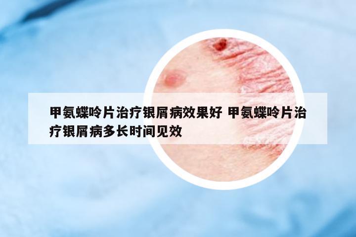甲氨蝶呤片治療銀屑病效果好 甲氨蝶呤片治療銀屑病多長時(shí)間見效