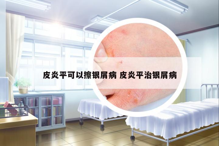 皮炎平可以擦銀屑病 皮炎平治銀屑病