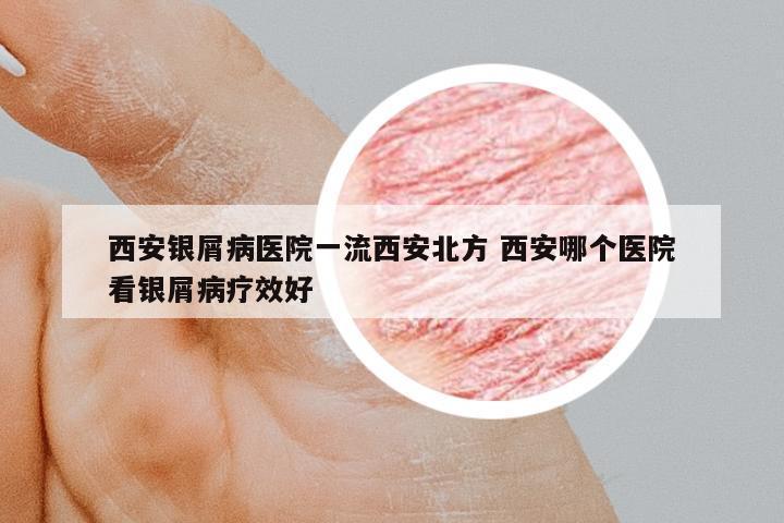 西安銀屑病醫(yī)院一流西安北方 西安哪個(gè)醫(yī)院看銀屑病療效好