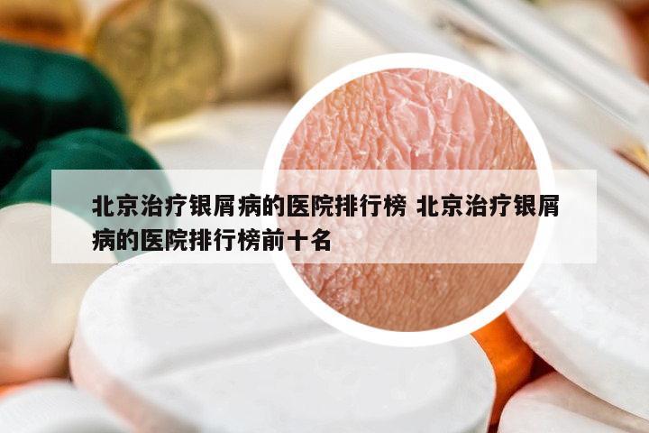北京治療銀屑病的醫(yī)院排行榜 北京治療銀屑病的醫(yī)院排行榜前十名