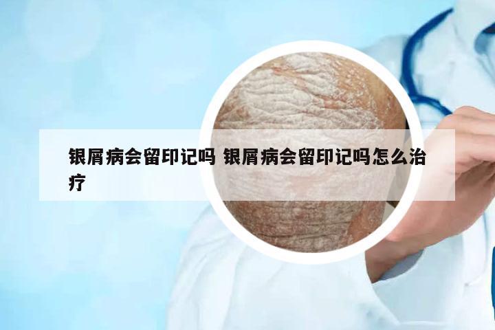 銀屑病會留印記嗎 銀屑病會留印記嗎怎么治療