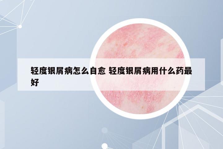 輕度銀屑病怎么自愈 輕度銀屑病用什么藥最好