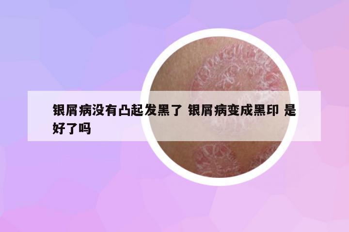 銀屑病沒(méi)有凸起發(fā)黑了 銀屑病變成黑印 是好了嗎