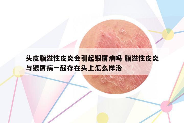 頭皮脂溢性皮炎會引起銀屑病嗎 脂溢性皮炎與銀屑病一起存在頭上怎么樣治