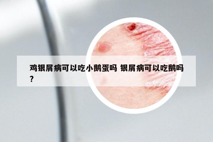 雞銀屑病可以吃小鵝蛋嗎 銀屑病可以吃鵝嗎?
