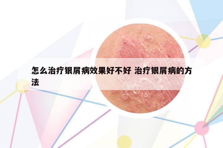 怎么治療銀屑病效果好不好 治療銀屑病的方法