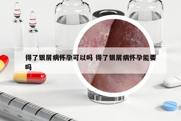 得了銀屑病懷孕可以嗎 得了銀屑病懷孕能要嗎