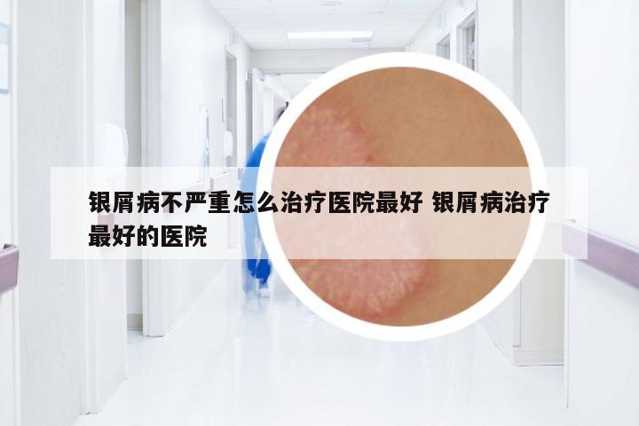 銀屑病不嚴重怎么治療醫(yī)院最好 銀屑病治療最好的醫(yī)院