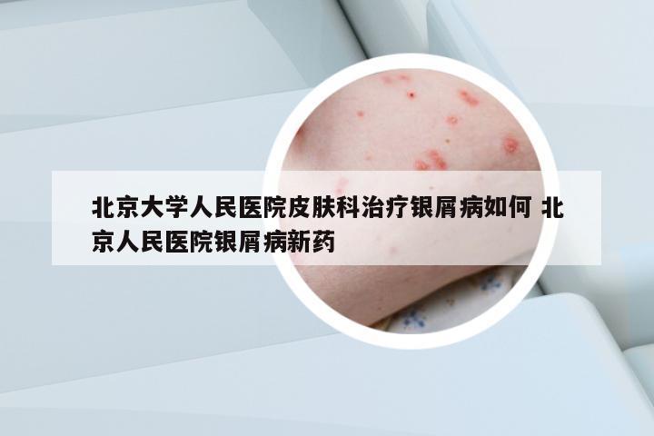 北京大學(xué)人民醫(yī)院皮膚科治療銀屑病如何 北京人民醫(yī)院銀屑病新藥