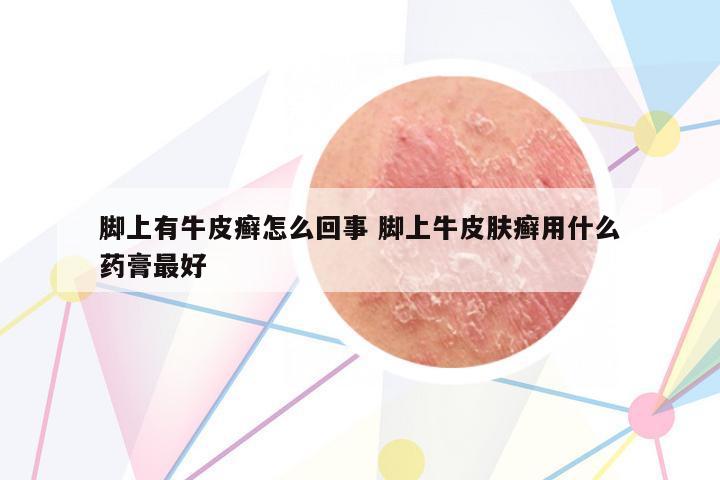 腳上有牛皮癬怎么回事 腳上牛皮膚癬用什么藥膏最好
