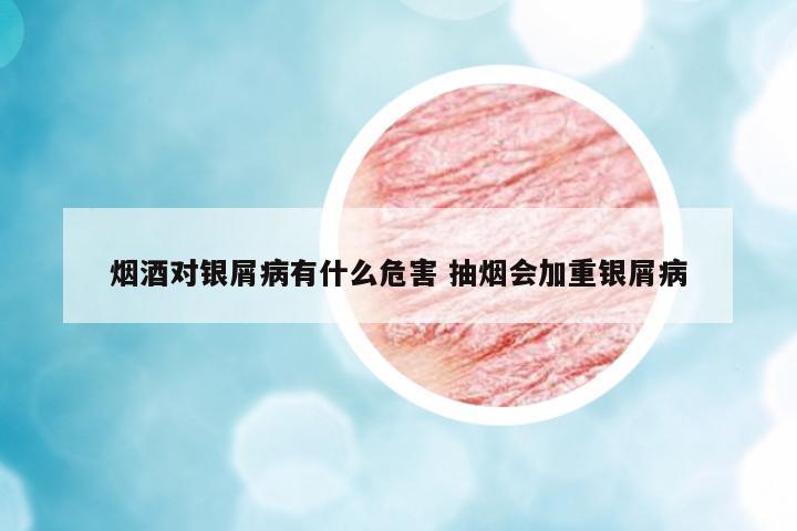煙酒對(duì)銀屑病有什么危害 抽煙會(huì)加重銀屑病