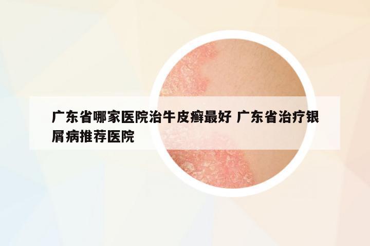 廣東省哪家醫(yī)院治牛皮癬最好 廣東省治療銀屑病推薦醫(yī)院