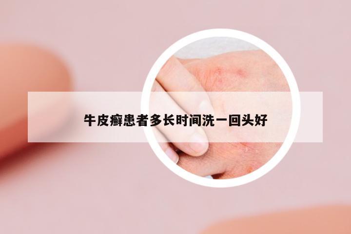 牛皮癬患者多長時間洗一回頭好