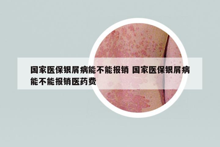 國(guó)家醫(yī)保銀屑病能不能報(bào)銷 國(guó)家醫(yī)保銀屑病能不能報(bào)銷醫(yī)藥費(fèi)
