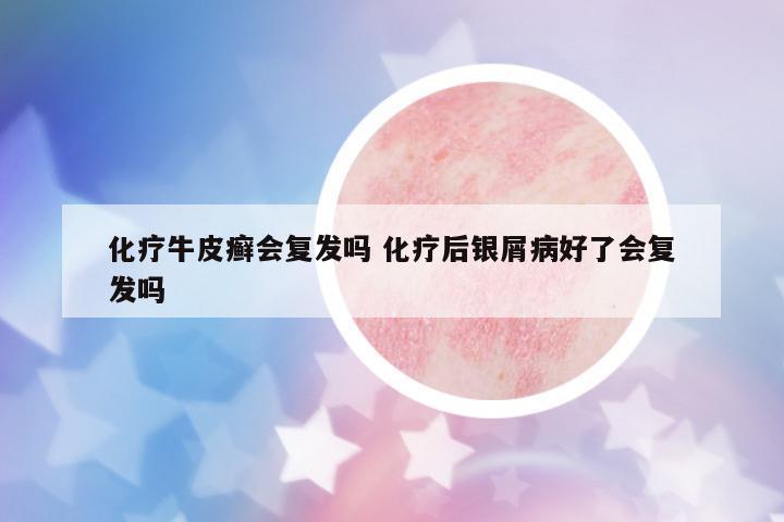 化療牛皮癬會復發(fā)嗎 化療后銀屑病好了會復發(fā)嗎